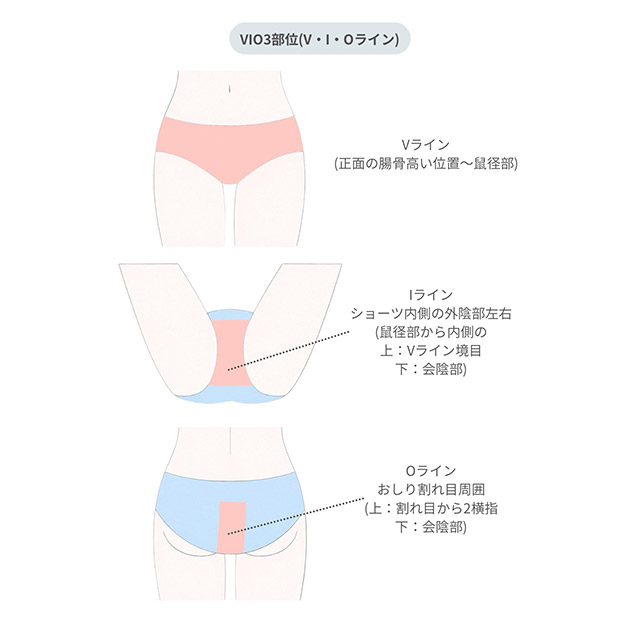 脱毛（女性）脱毛範囲表-VIO